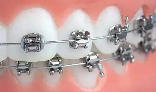 正畸出装前需要准备哪些材料?如何确保正畸出装顺利进行? 正畸出装前需要准备哪些材料?如何确保正畸出装顺利进行?